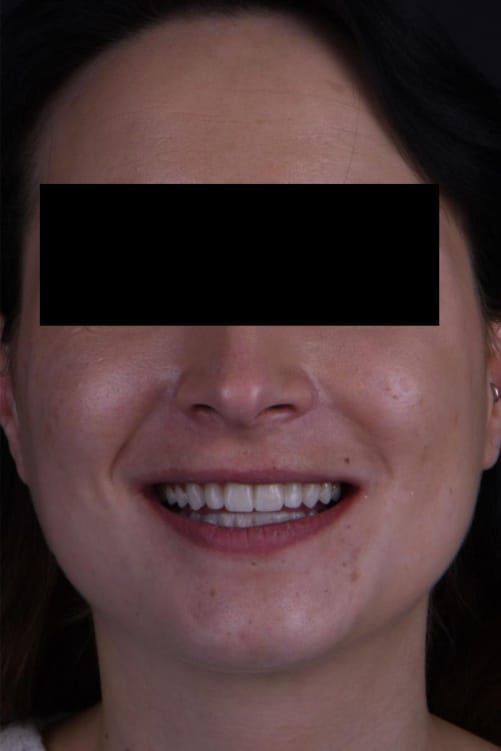 fullface